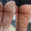 Was hilft gegen Cellulite? 